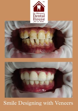 Dental care in baner - Dr. Dhruva's dental