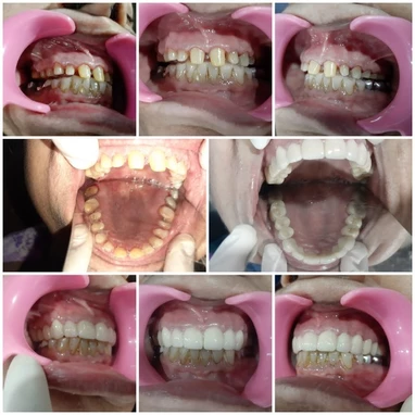 Teeth cleaning treatments in baner - Dr. Dhruva's