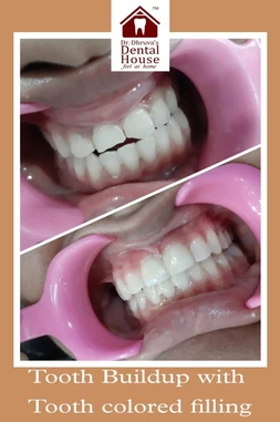 Teeth straightning inbaner