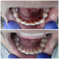teeth before after treatment