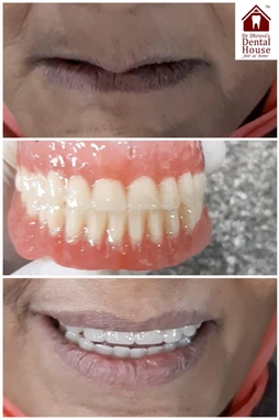 teeth cleaning & whitening treatment in baner