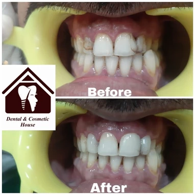 teeth whitening in baner