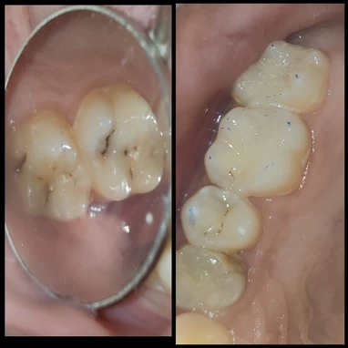 tooth feeling treatment
