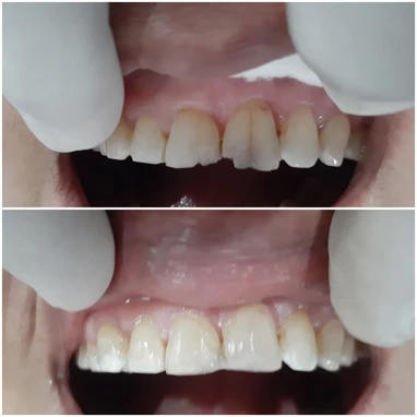 veeners treatment in baner